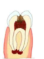 Granuloma apicale e ascesso dentale